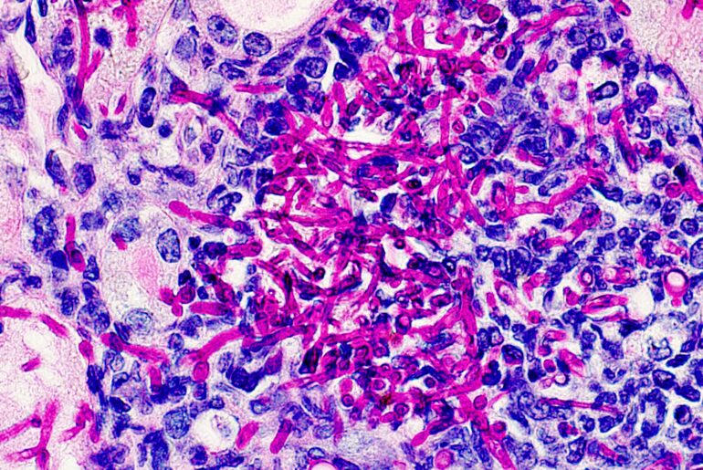 Study Points Toward Immune Reprogramming to Treat Candidiasis