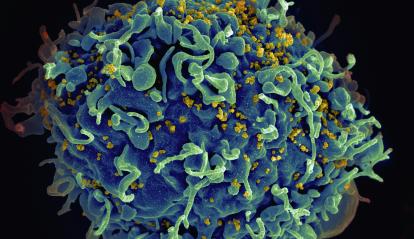 Scanning electron micrograph (SEM) of an H9 T cell infected with HIV.