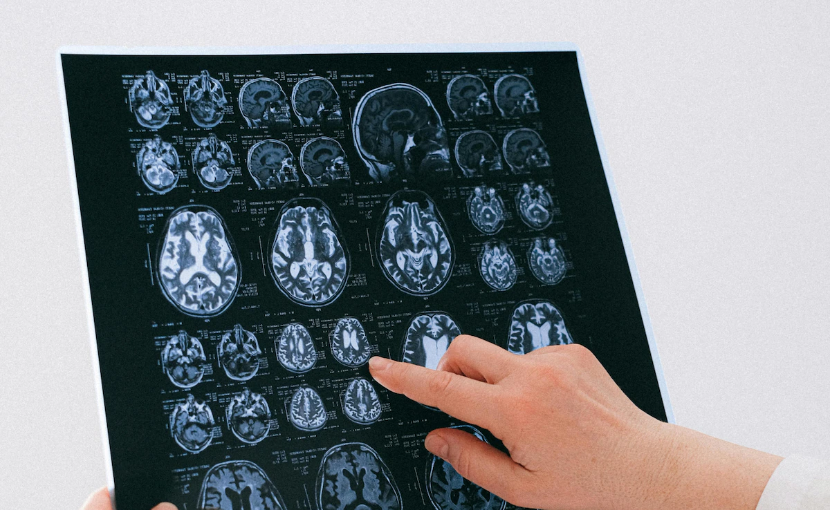 Is Vitamin D Deficiency A Risk Factor For Alzheimer's Disease? Study Answers