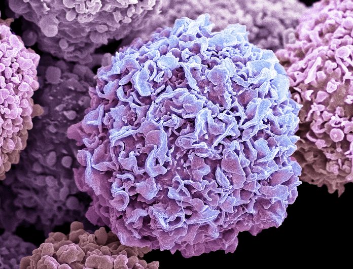 Breast cancer cells, SEM