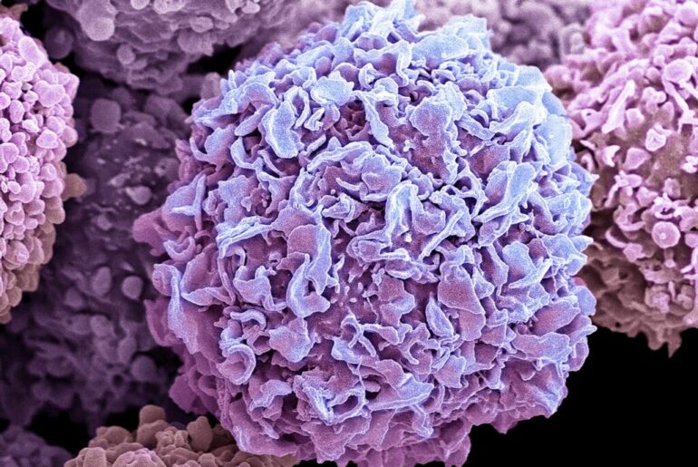 Immune Response Gene Variants Tied to Earlier Breast Cancer in BRCA1 Carriers