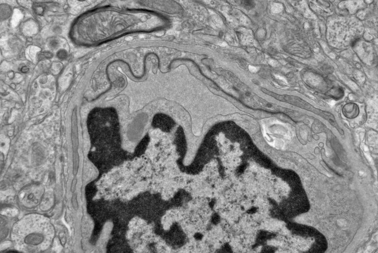 Fish oil may increase CTE risk after brain injury