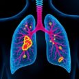 New Lung Cancer Model Uncovers How Tumor Location Influences Immune Response — Biology