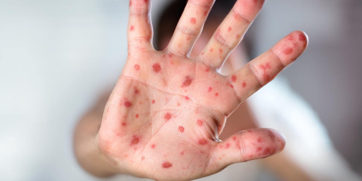 With measles in CSRA, should you get a test for immunity?