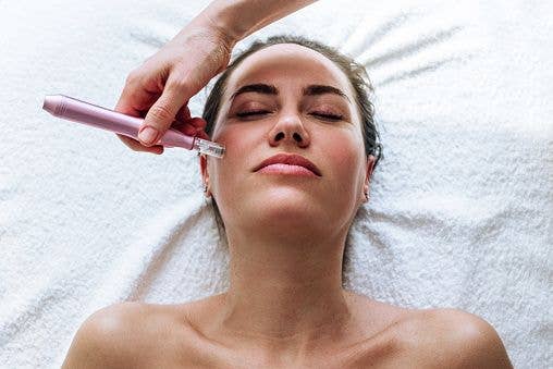 A woman having microneedling done 