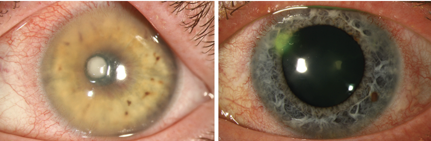Microbial keratitis tends to be more aggressive when it affects the central cornea (left) vs. the periphery (right), as the central cornea lacks the defensive complement proteins that the peripheral cornea possesses to fight off infections.