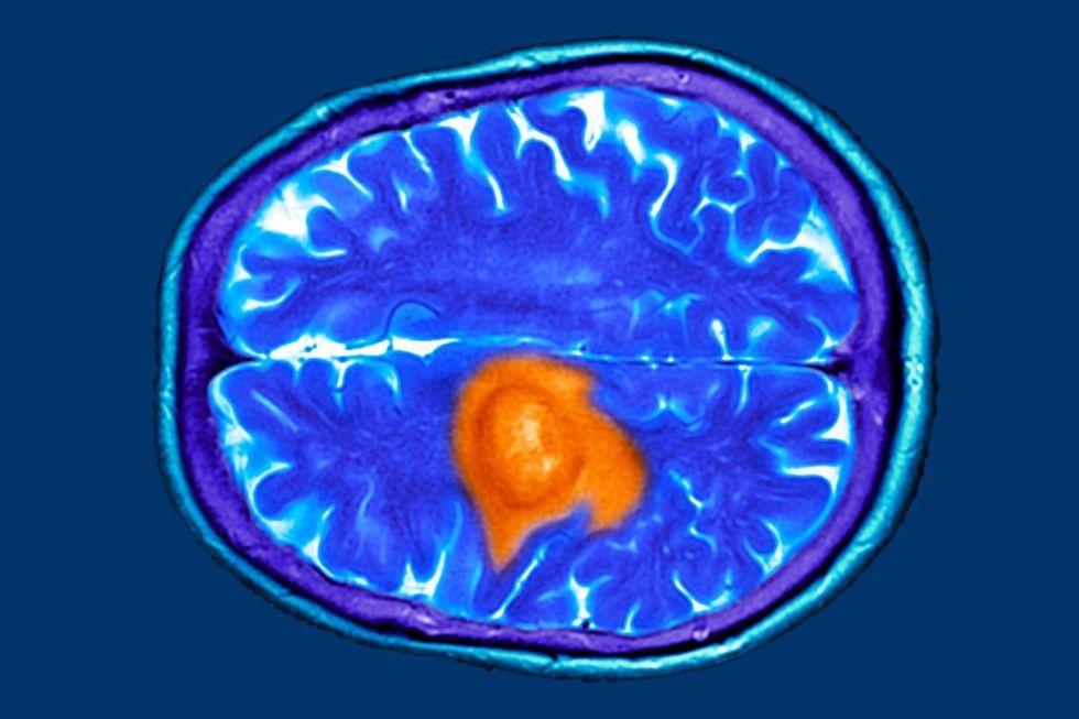 Brain scan MRI