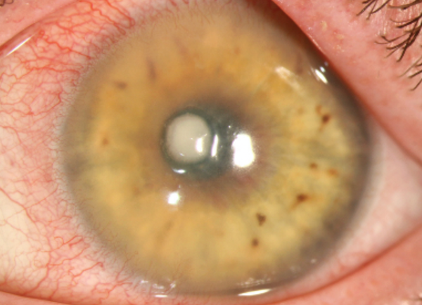 The Ocular Surface: An Inflammation War Zone