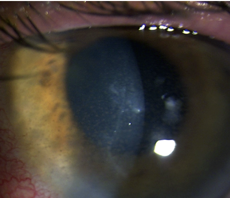 Keratic precipitates with anterior chamber reaction and stromal haze—all hallmarks of HSV endothelial keratitis.