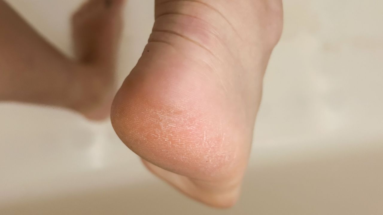lavinso foot peel 