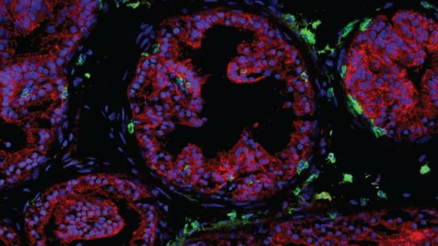 T Cells in Prostate To Advance Cancer Therapy
