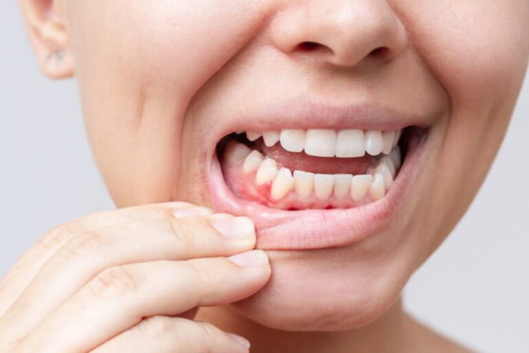 Matrix Stiffness Regulates Gingival Immunity