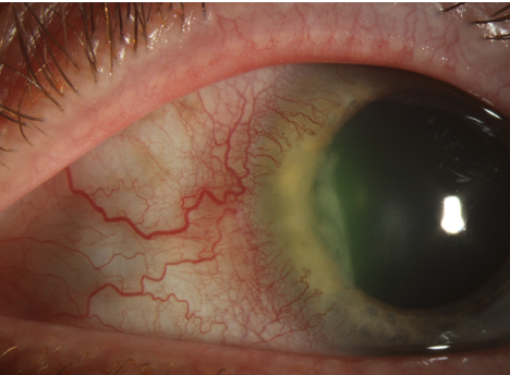 Peripheral ulcerative keratitis, a noninfectious form of keratitis, causes severe inflammation, progressive thinning and crescent-shaped ulcerations, often yellowish or gray, at the stromal layer.