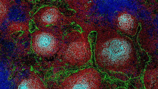 Lymphoma Disrupt Immune System Structure