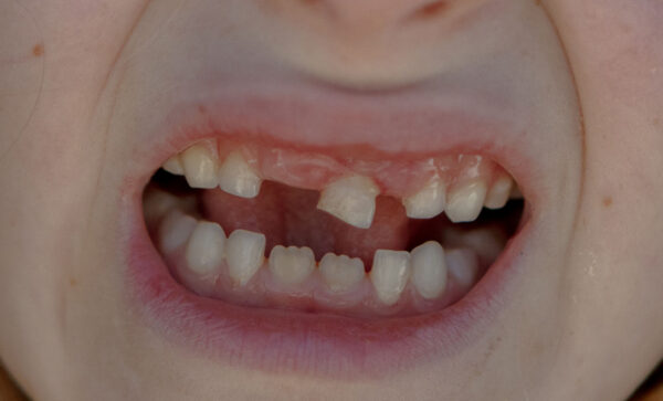 A photograph by Emily Peacock of a child's mouth with some missing teeth and a visibly loose baby tooth.