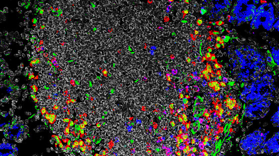 Discovery of immune tolerance switch could yield better IBD treatments