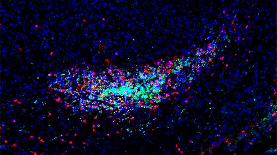 T cells secrete DNA to help immune system fight cancer