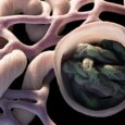 Protein Supplement Tied to Better Outcomes for Patients on Dialysis