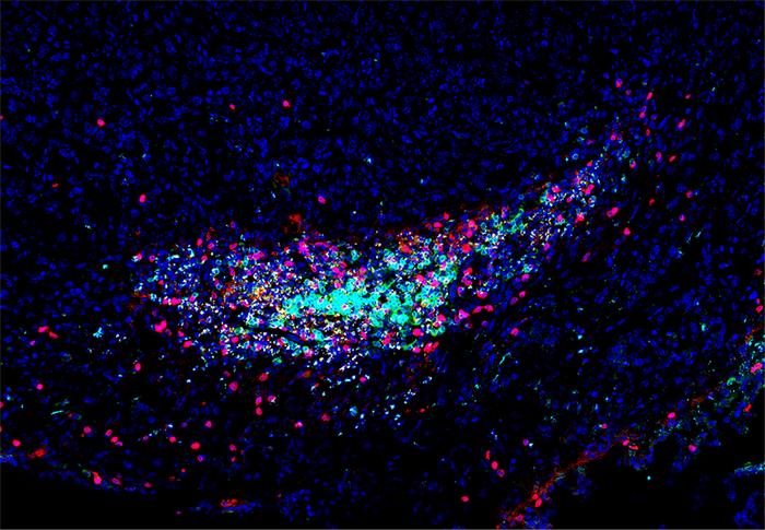 An immune cell aggregate known as a tertiary lymphoid structure located within a pancreatic cancer as a result of treatment with activated T cell extracellular vesicle DNA and immune checkpoint blockade. [Mengying Hu]