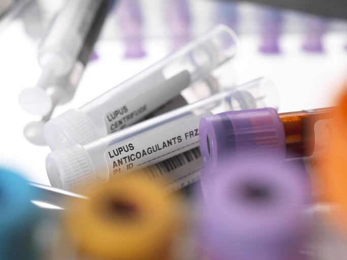 Lupus anticoagulants on a surgical tray. Systemic lupus erythematosus (SLE) is an autoimmune condition that is nine times more likely to affect women than men.