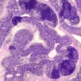 Chronic bowel disease involves multiple types of inflammation happening at once
