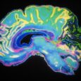 Exhausted brain immune cells drive aggressive multiple system atrophy