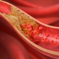 Artery with cholesterol clogging the sides