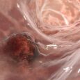 Broader Immune Targeting Increases Immunotherapy Benefit in Colorectal Cancer
