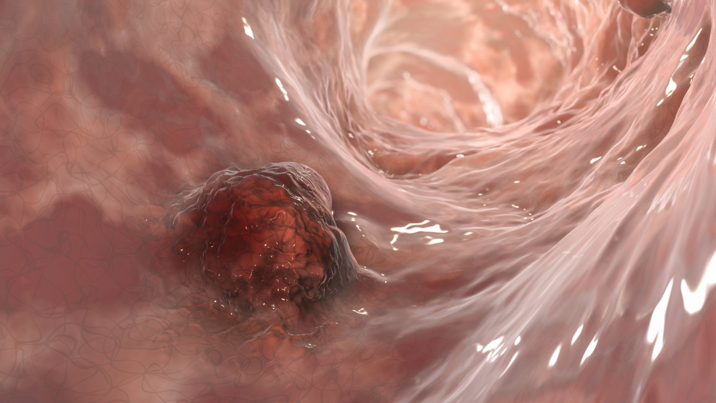 Broader Immune Targeting Increases Immunotherapy Benefit in Colorectal Cancer