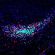 An immune cell aggregate known as a tertiary lymphoid structure located within a pancreatic cancer as a result of treatment with activated T cell extracellular vesicle DNA and immune checkpoint blockade. [Mengying Hu]