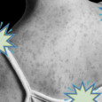 The Long-Term Measles Complication Most People Don't Know About