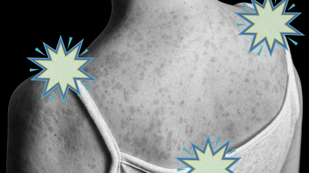 The Long-Term Measles Complication Most People Don't Know About