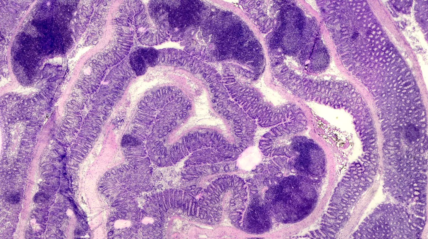 Chronic Bowel Disease: Multiple Inflammations Found