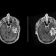 glioblastoma brain scan