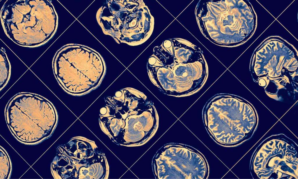 Simple amino acid supplement may help fight Alzheimer’s disease