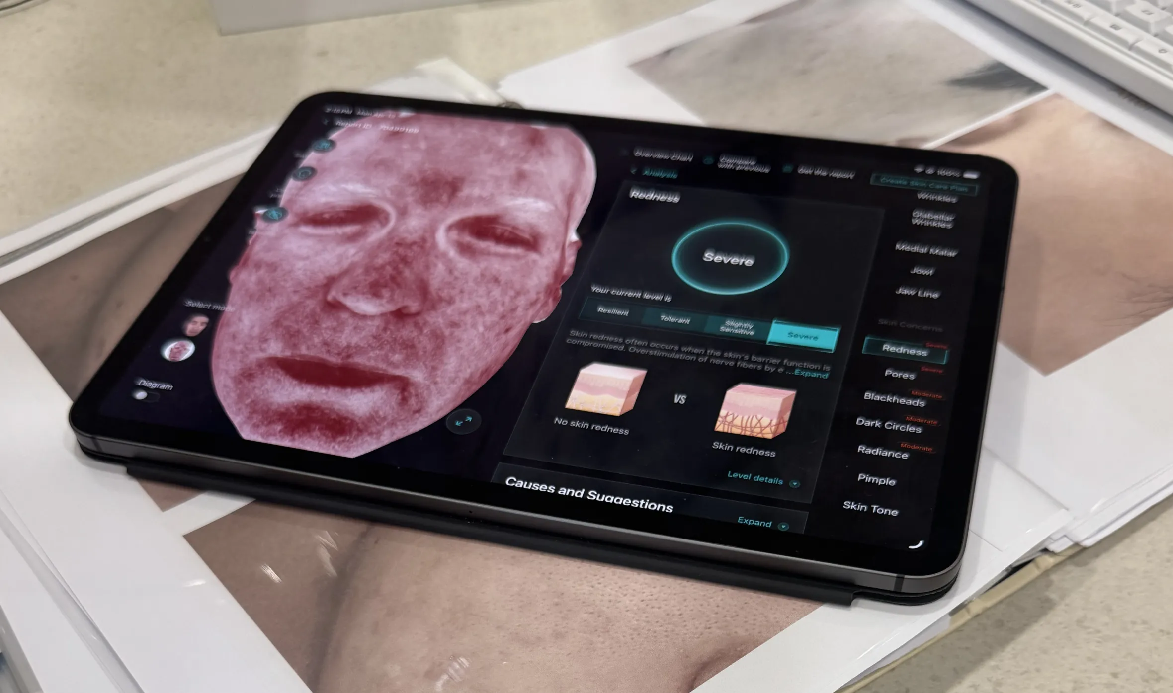 Tablet showing results from a 3D facial scan indicating "Severe" redness and skin concerns.