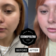 RHA Lip Filler Review: My Honest Before-and-After Results