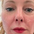 XERF Latest Skin Tightening From Korea: Review and Tested