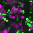 First video of immune cells eating live skin cancer in real time