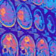 new imaging study sheds light on cancer immunotherapy