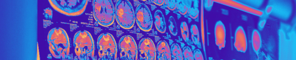 new imaging study sheds light on cancer immunotherapy