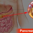 New research reveals how pancreatic cancer hides from the immune system