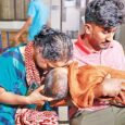 Measles death rises due to malnutrition, children missed vitamin-A including vaccine