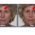 Plexaderm’s Latest Beauty Buzz Focuses on Fast Results Without the Filters