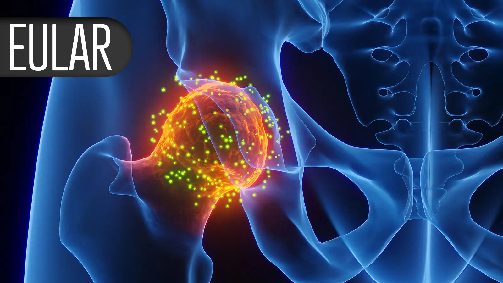 Novel Concept, 'Immune Dimming,' Explored in Rheumatoid Arthritis