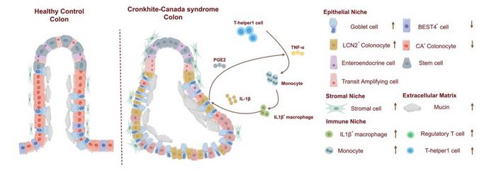 Key characteristics of intestinal hamartomatous polyposis in Cronkhite–Canada syndrome and the TNF-α/IL-1β/PGE₂ axis