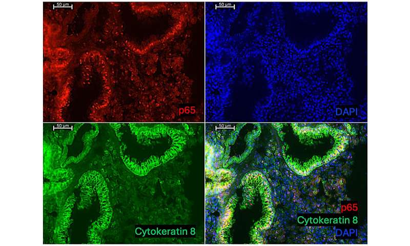 Immunohistochemical staining of mouse lung sections with anti-p65 and anti-cytokeratin 8 antibodies, two hours after TLR5 agonist treatment. Credit: Yosuke Sakamachi A hidden link between immune system and microbiome may explain the origin of mysterious lung disease