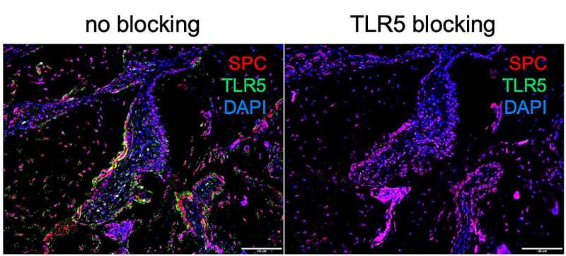 Immunohistochemical staining of TLR5 in human IPF lung sections. Credit: Yosuke Sakamachi A hidden link between immune system and microbiome may explain the origin of mysterious lung disease